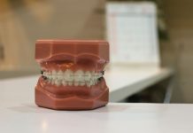 What You Need to Know About Your Wisdom Teeth